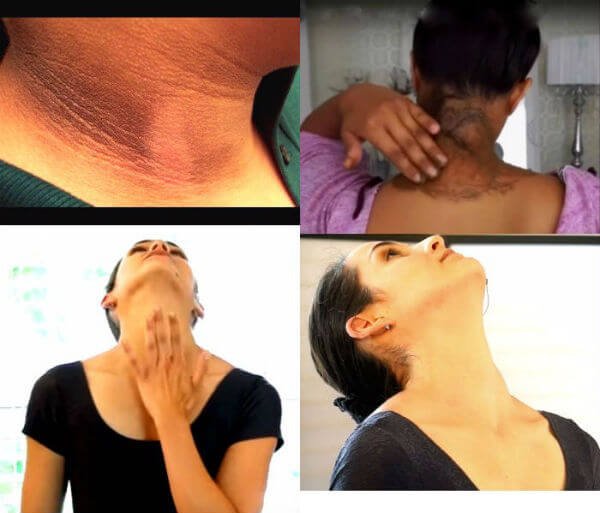 गर्दन का कालापन /Black dark neck remedies in hindi