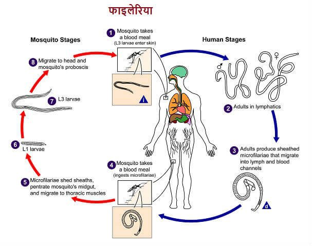 फाइलेरिया रोग क्या है ? कारण, लक्षण और बचाव की जानकारी filaria ke lakshan karan bachav upchar